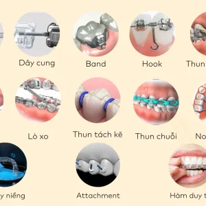 Các loại khí cụ chỉnh nha