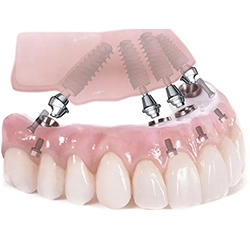 Hybrid - all on x trên implant